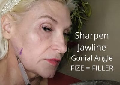Sharpen Jawline – Gonial Angle –  Fize as a Filler