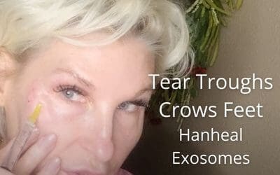 Crows Feet and Tear Troughs – Hanheal Exosomes – Skin Booster