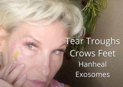 Crows Feet and Tear Troughs – Hanheal Exosomes – Skin Booster