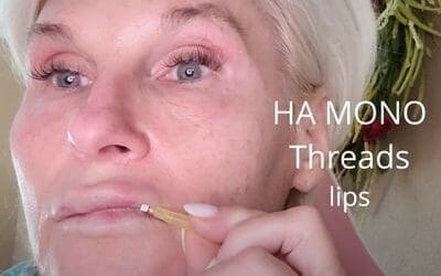 Aging Lips – Full Lips with HA Mono Threads