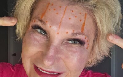 Tox Placement and Dehantox Use