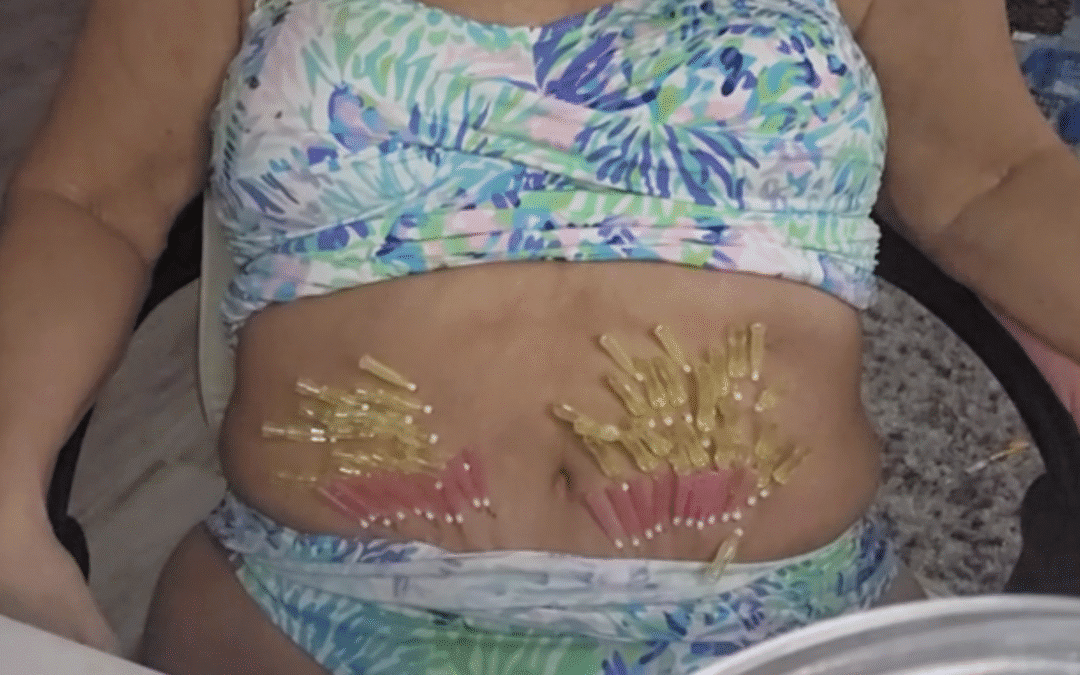 Tightening Abdominal Area with Threads