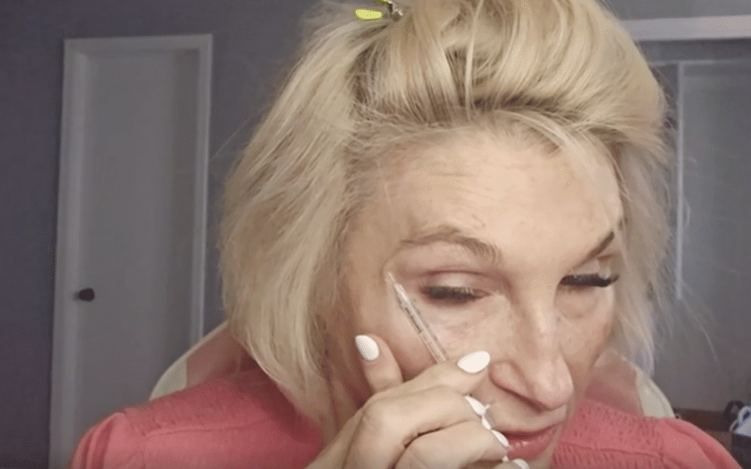 Toxing Crows Feet & Platysmal Bands