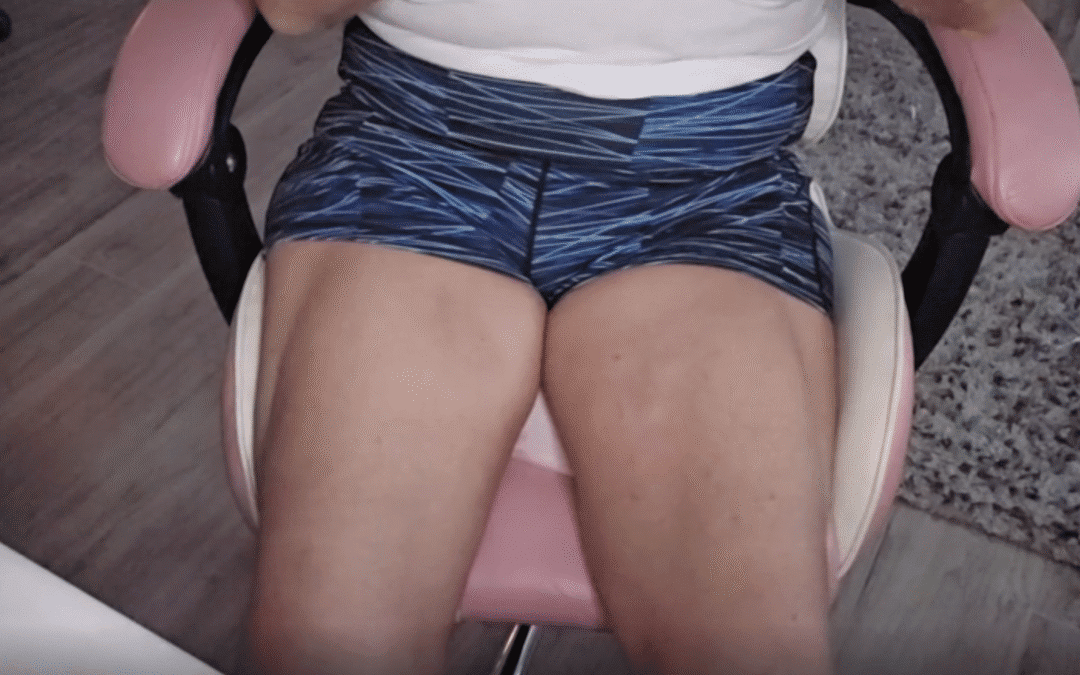 Thigh Lift with Cog Threads