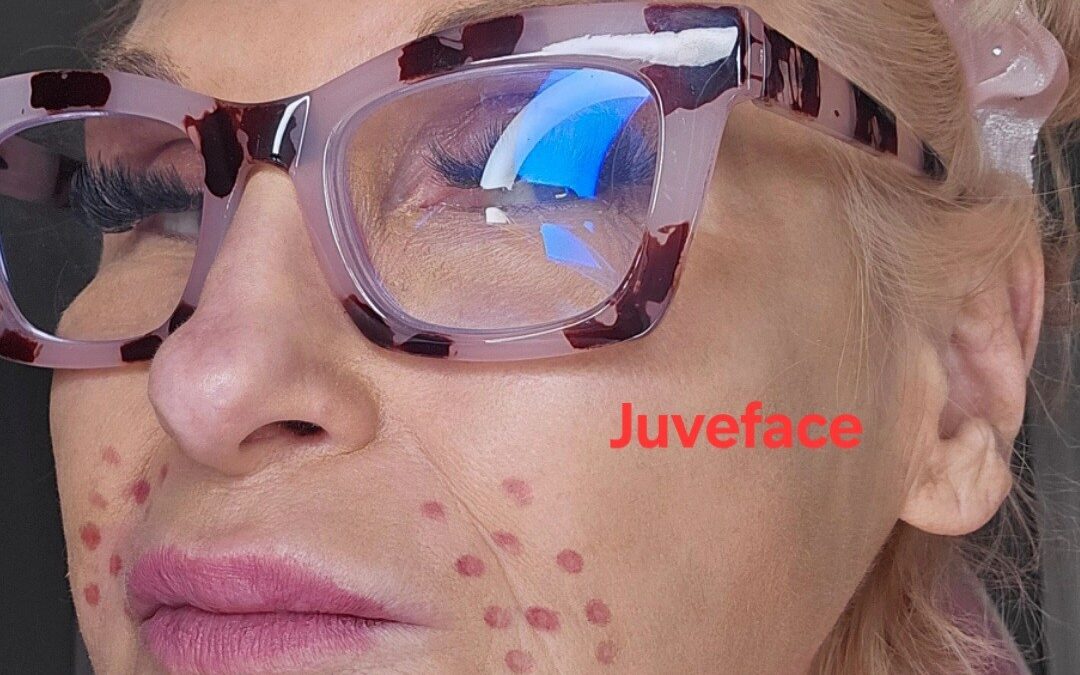 Hatch Pattern for NL Folds with Juveface