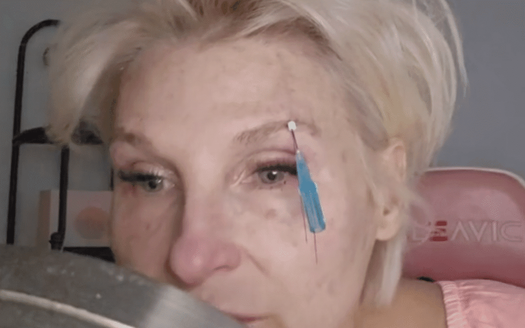 Brow Lift with CSL Cogs from AceCosm