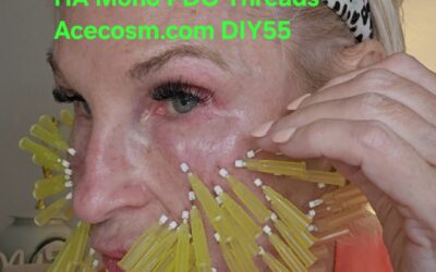 Face Lift with HA PDO Mono Threads